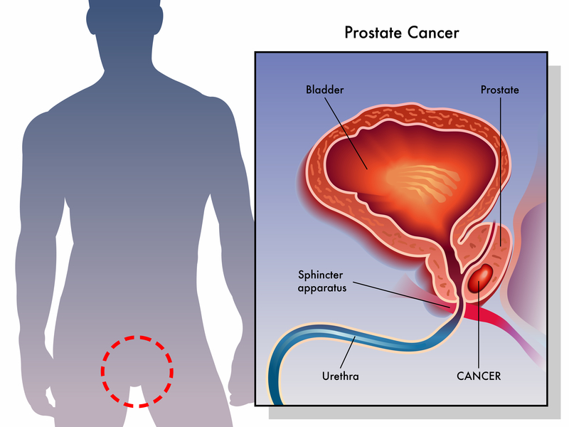 Prostate And Ed Problems Does Prostate Cancer Cause Impotence